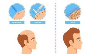 Hair Transplant Techniques in 2025: Costs, Success Rates & Best Options in the UK