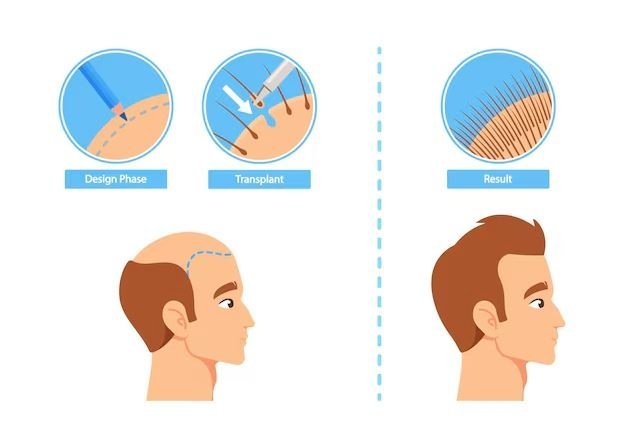 Hair Transplant Techniques in 2025: Costs, Success Rates & Best Options in the UK