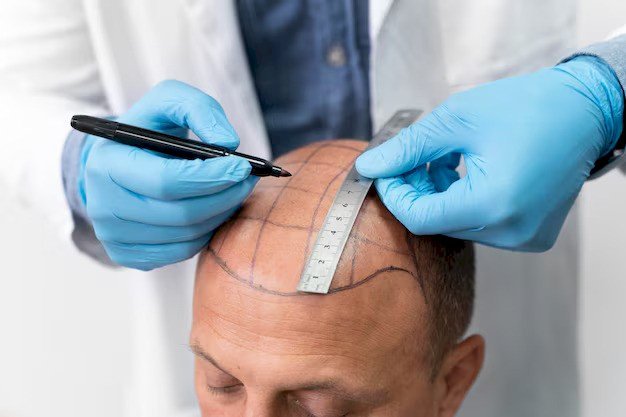 Hair Transplant Cost in 2025: UK & Global Prices, Factors
