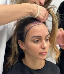 Hair Transplant Cost in 2026: UK & Global Prices, Factors