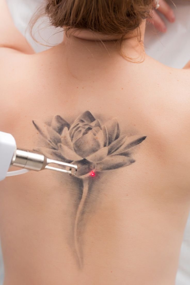 5 Best Tattoo Removal Companies in the United States